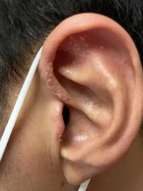 $冠昊生物(sz300238)$ 这个耳部的银屑病,今天配一