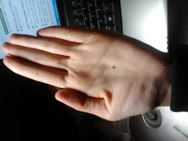 我从小就发现左手手心有颗痣 在正中间,特正 想问问好不好?