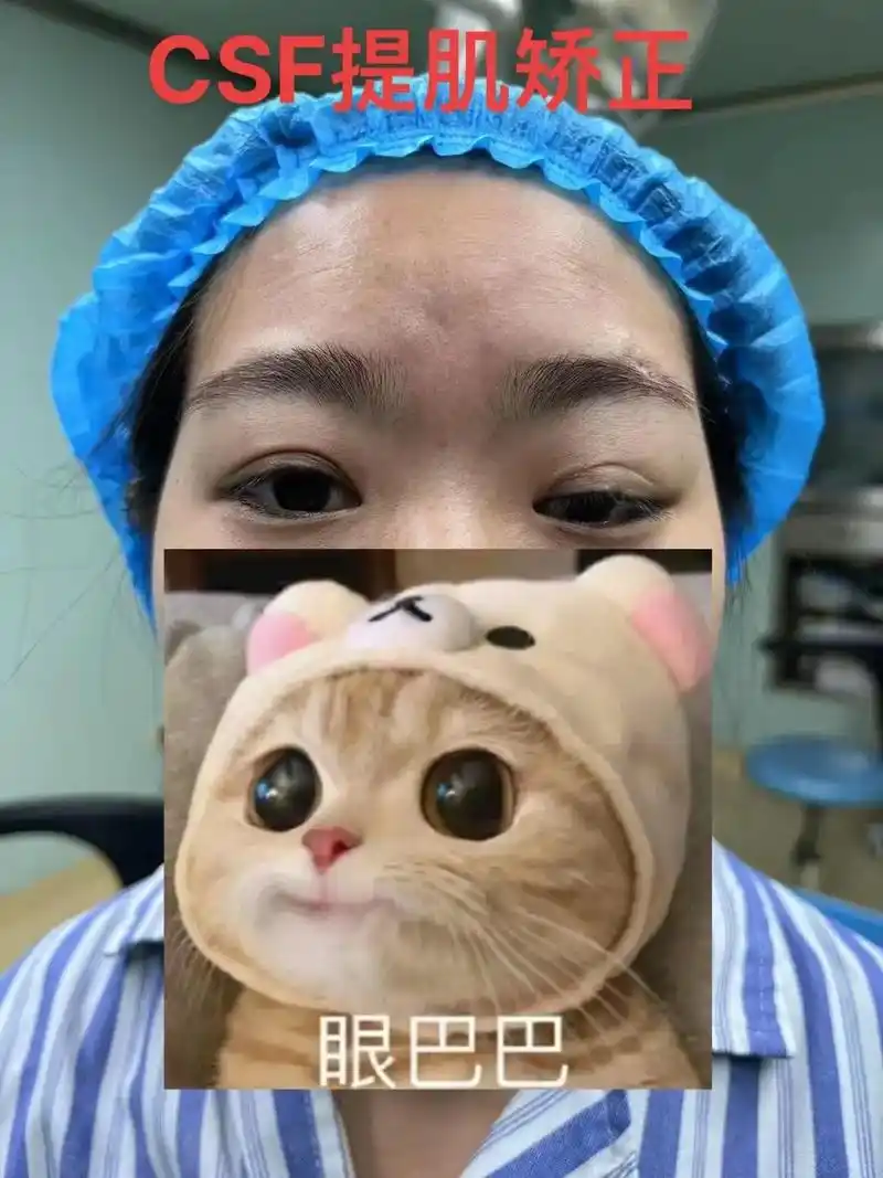 问题性眼综合修复.#双眼皮 #现场实拍 修复型提肌无力好评[ - 抖音