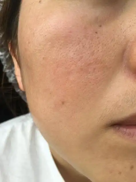 脸颊全是黑头毛孔粗大 请问我脸上鼻子两边毛孔粗大怎么办?