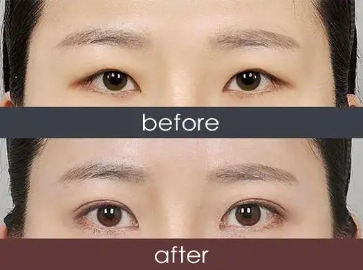 韩式三点定位双眼皮前后对比案例