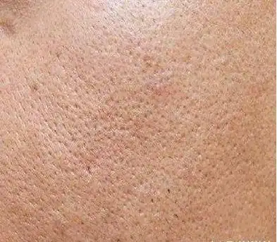 你脸上的角质太厚了!有八成的女人不懂得如何正确去角质