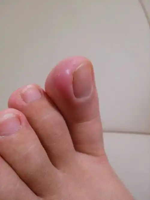 这大脚趾头是长什么呢?一碰就很痛,有什么药可以涂的么?