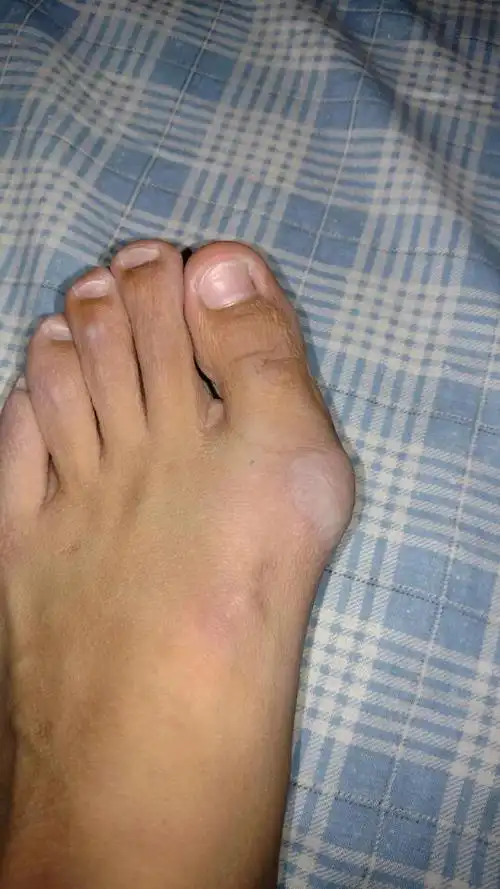 左脚脚拇指外翻,治疗大概多少费用.遗传的,妈妈也是,外婆也是.