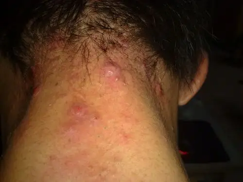 脖子后面,颈部,反复的发作,请问这是什么病?