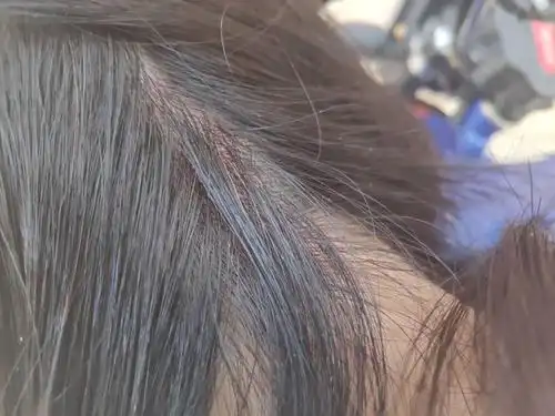 头皮发红怎么回事年龄18女