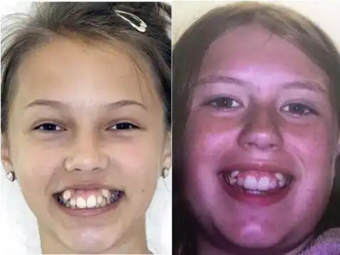 王俊凯的虎牙改变方法,值得每一位有虎牙的人好好学习|牙齿|尖牙|牙套