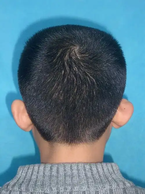 各式各样的耳廓畸形-杯状耳_耳部整形_耳部整形症状 - 好大夫在线