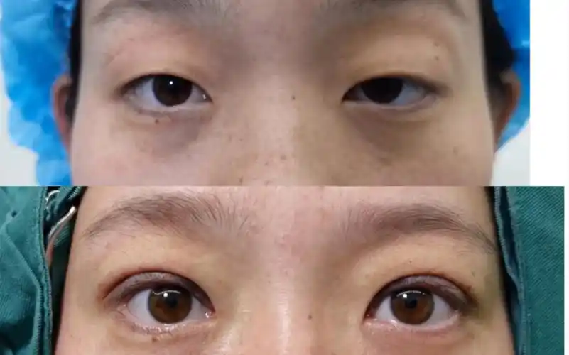 双眼眼睑下垂矫正效果:姑娘自幼大小眼06,检查后发现双眼上睑下垂