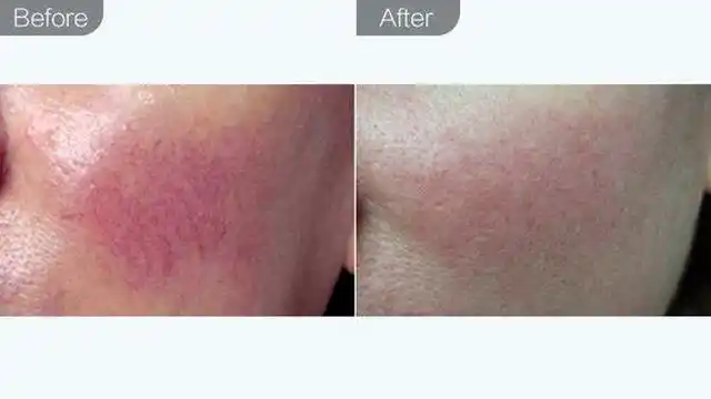 任何皮肤问题去红血丝是第一步来看看三甲医院医生怎么说