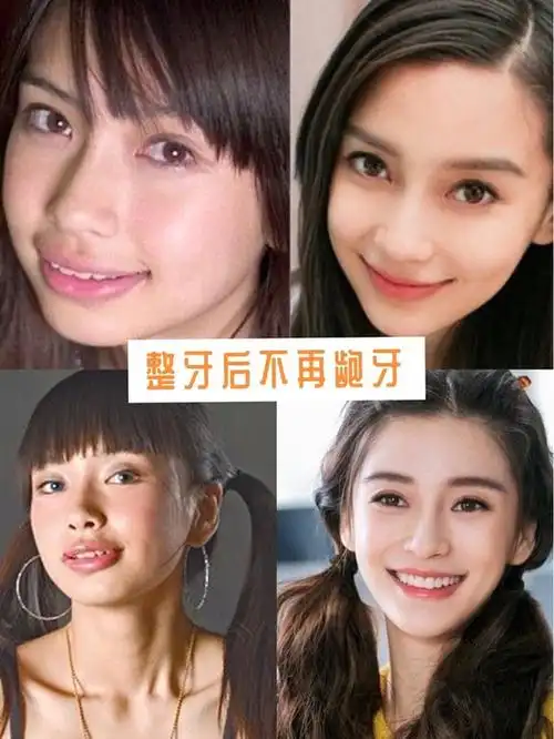 认识的许多明星其实也是有过牙齿矫正的,例如小s,高圆圆,angelababy