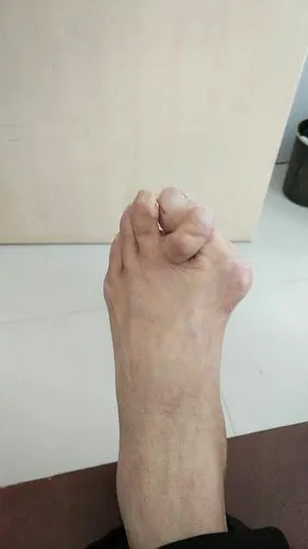 简便快捷又美观2017-03-22 微创治疗踇外翻拇外翻(hav)俗称"大脚骨