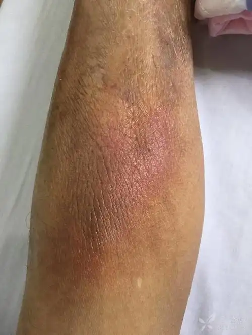 急性早幼粒细胞白血病患者合并皮肤改变