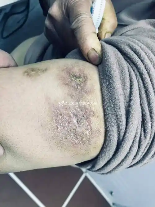 典型皮损狼疮性脂膜炎