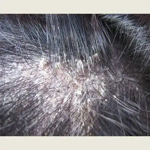 哪个品牌的洗发水能够舒缓敏感头皮屑和止痒感