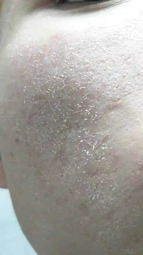 皮肤干燥紧绷怎么办