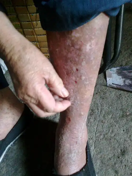 老人秋冬季皮肤瘙痒怎么办?