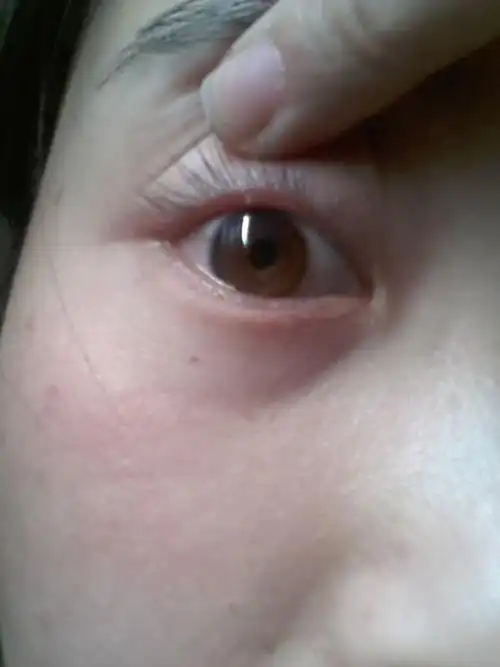 眼皮上长了个这个疼疼的上眼皮都肿了