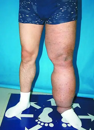 摔一跤左腿成"象腿" 比常人粗两倍|整形|象皮肿_新浪女性_新浪网