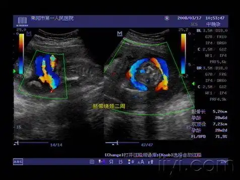 胎儿脐带绕颈及唇部欣赏 - 超声医学讨论版 - 爱爱医医学论坛