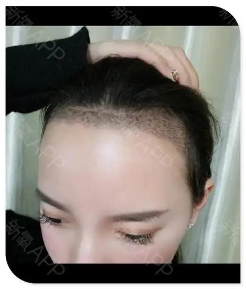 东莞种植发际线好不好_效果图_三岁想法种植发际线术后第7天_新氧美容