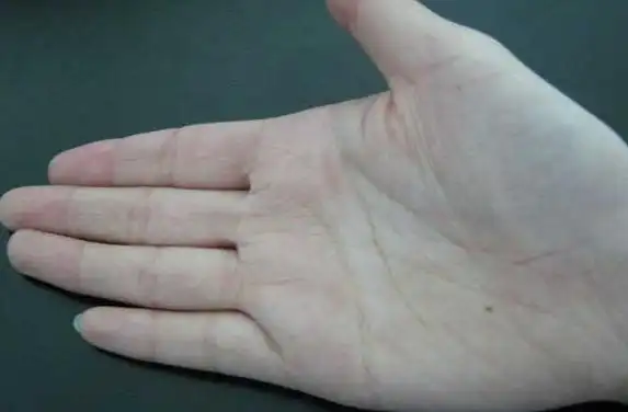 q1:怎样的手纹提示身体有癌症?