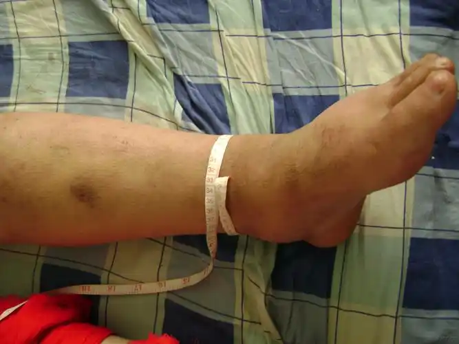 大家谁见过橡皮腿丝虫病这个像不像我没见过