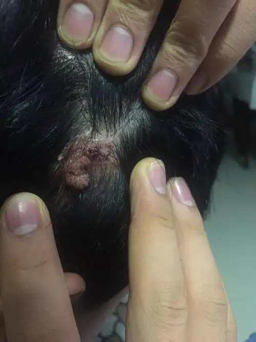 头上长的瘊子,小时候就有,随着我长大,他也在长.