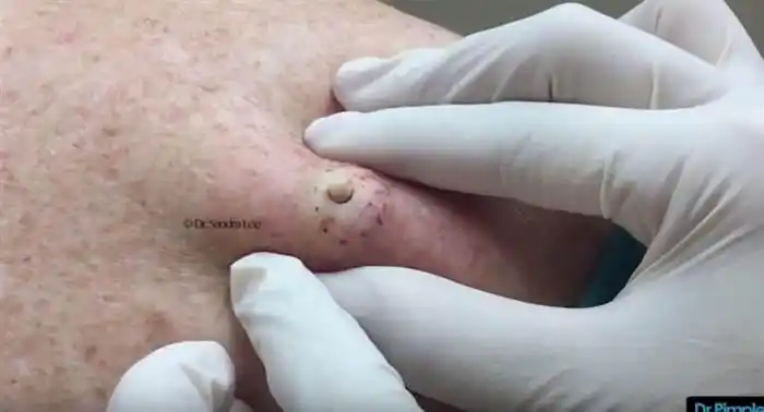 背上浓疮痛不欲生,医生用手术针开一个洞,瞬间脓疮「爆浆」像蚯蚓般