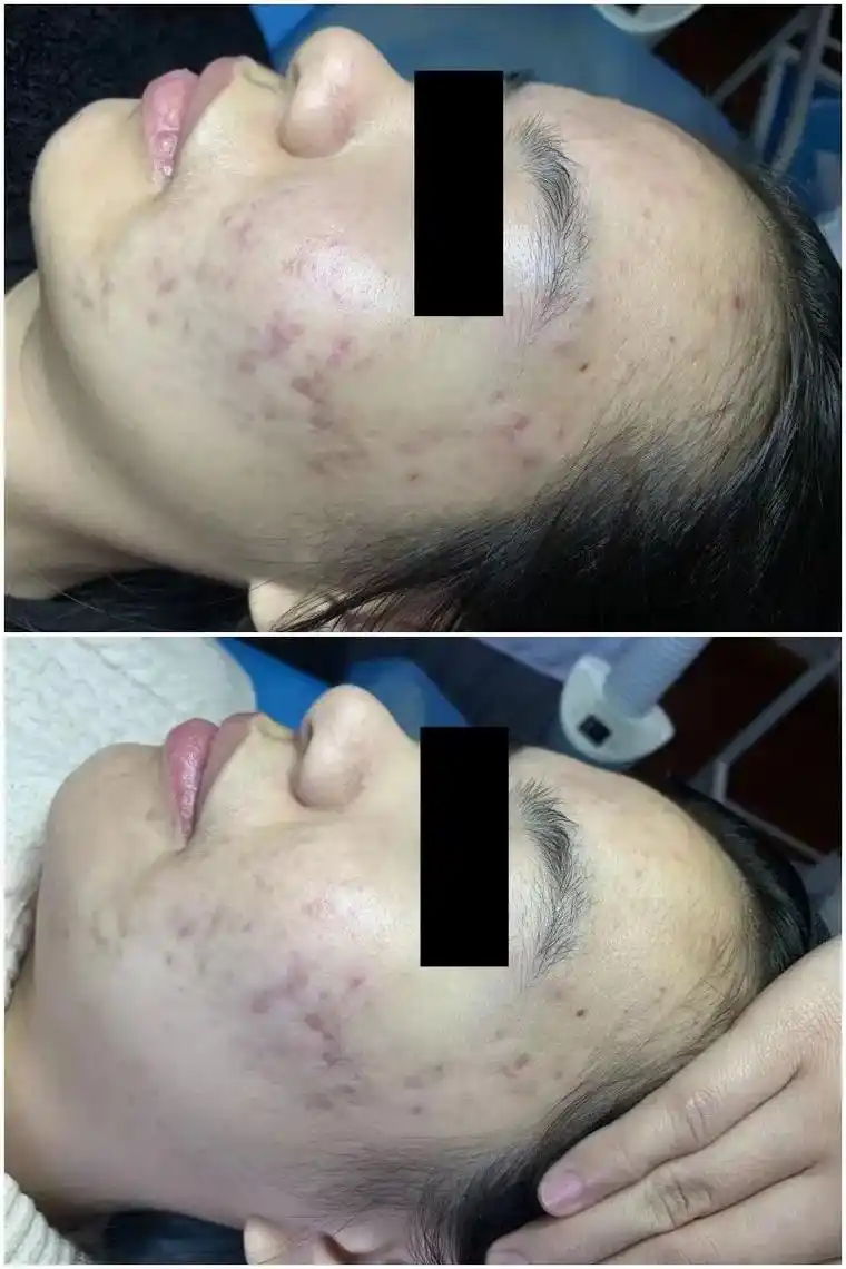 小姐姐三次纯中药祛痘的效果炎症基本控制住了