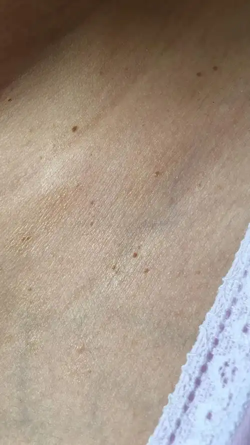 怀孕期间脖子的小丘疹叫做皮赘,没有传染性