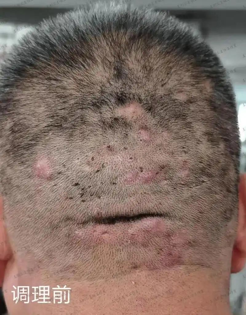 头皮出油多,毛囊炎反复,中医调理有妙招  我曾经遇到一位患者,得毛囊