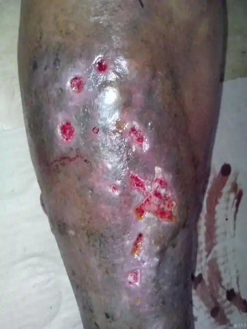 18天治愈老烂腿 - 中医皮肤版 - 爱爱医医学论坛 - 爱爱医医学网