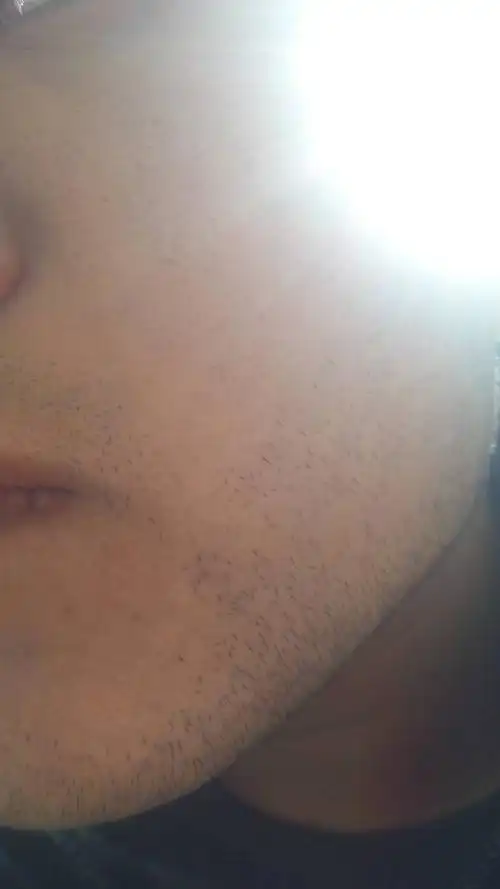 我男孩,23岁,身体长了很多胸毛和络腮胡,这样以后找媳妇好找吗,会不会