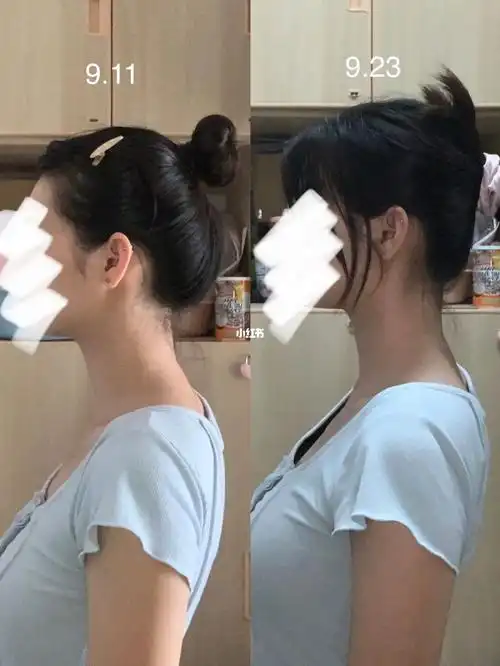 懒人两周75脖子前倾圆肩驼背别来60