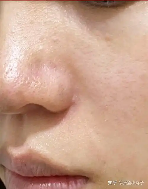 男生毛孔粗大皮肤很黑很粗糙怎么办