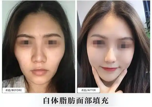 脂肪填充全脸脂肪填充面部多久恢复好面部脂肪填充注意事项