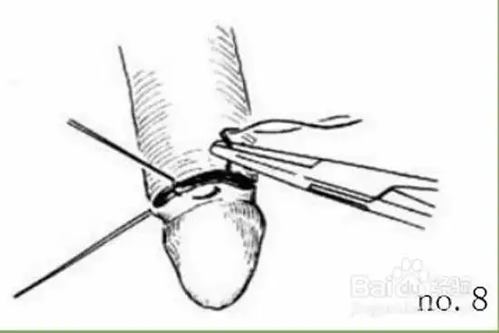 割包皮最佳年龄及过程价格?