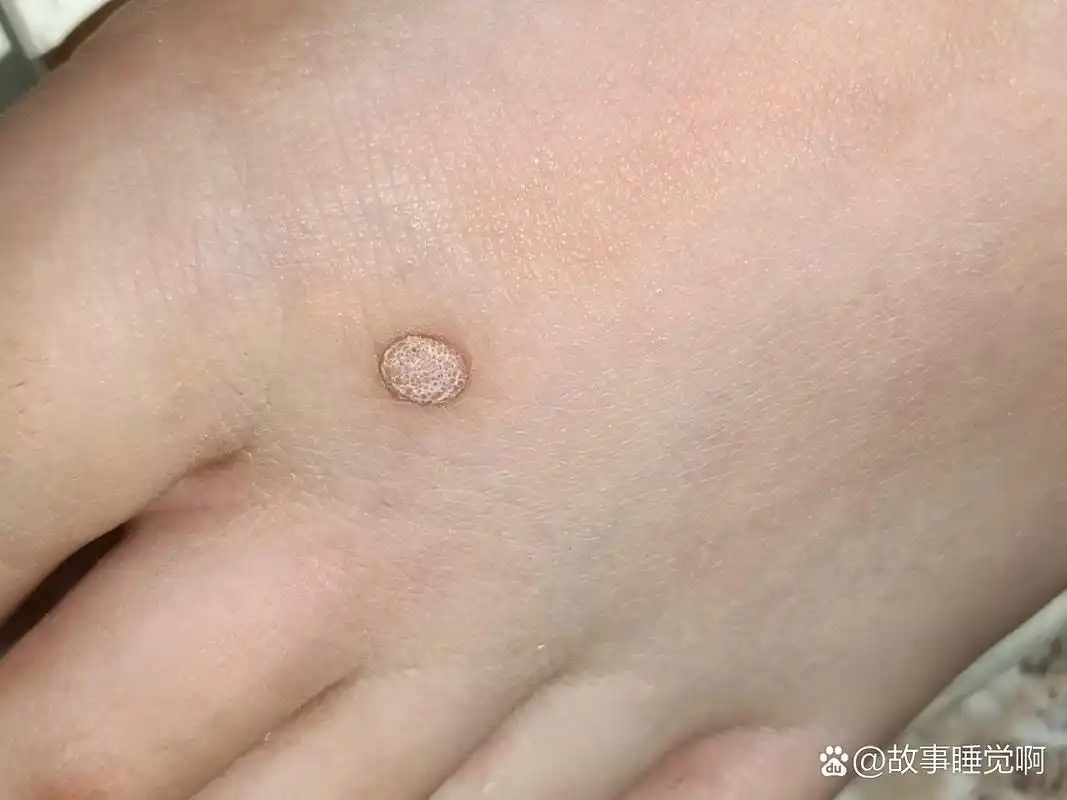 脚上长了一个肉疙瘩怎么回事啊.求解答