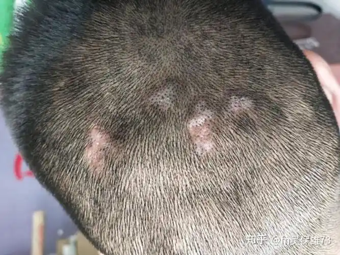 有什么可以彻底根治头皮毛囊炎的方法