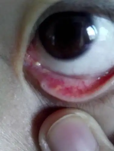 这是什么,今天发现眼角里面涨了一个豆豆一样的东西还有脓的 样子?