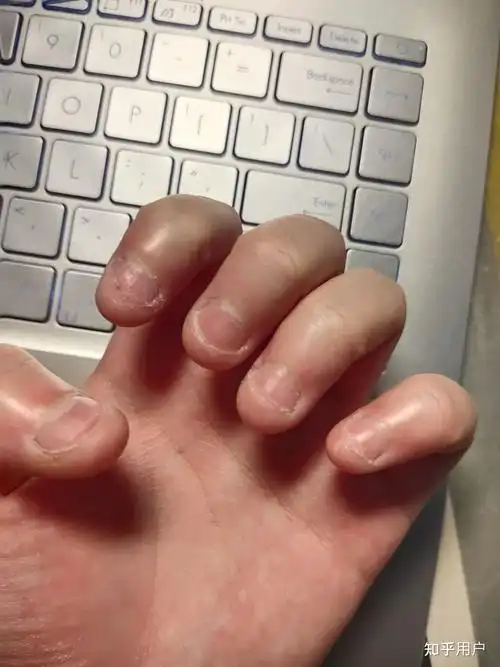 成年人依然有啃手指甲的行为如何戒掉