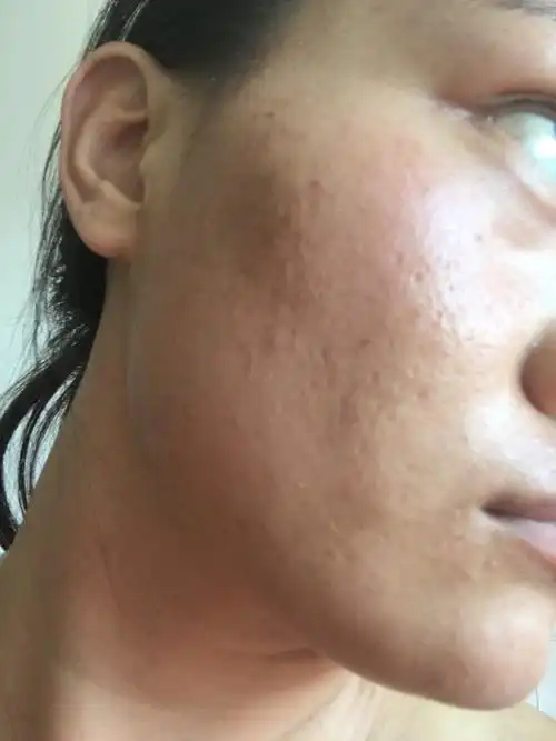 痘坑,色素沉着,皮肤粗糙问题