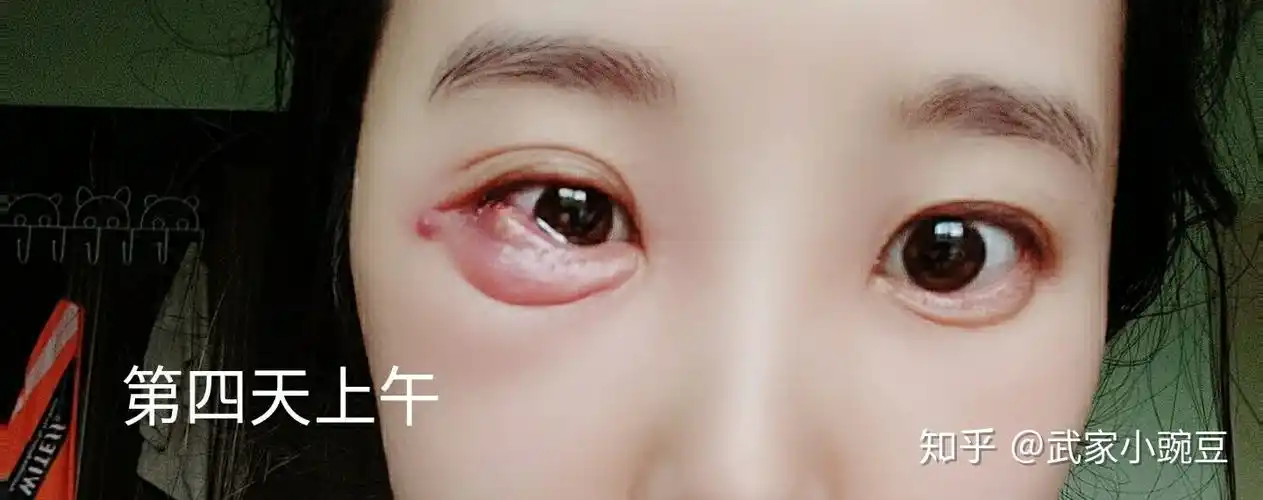 与巨型麦粒肿斗争的一周