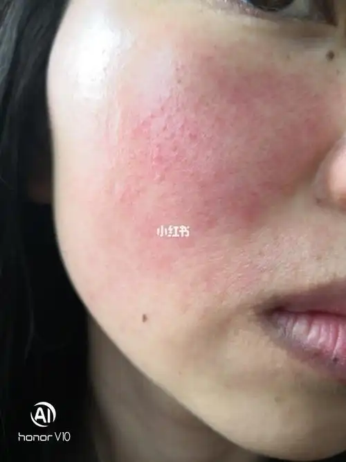 黄连素湿敷失败严重角质层受损的最好小面积试用不要大面积湿敷不然会