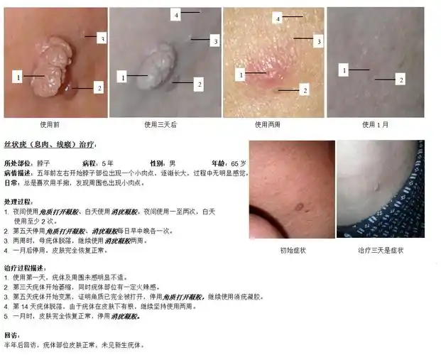 消疣凝胶套装-疣/瘊/病毒感染/消疣凝胶套装