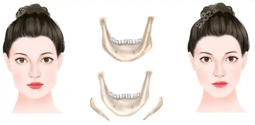 刘先超磨骨手术技术挺好,这有他磨下颌角的价格,风格介绍,颌面对比照