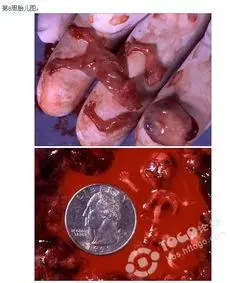 药流干净小技巧 怀孕药流危险性大吗