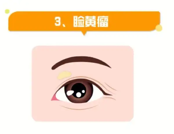 眼睛长了一个疙瘩要紧吗