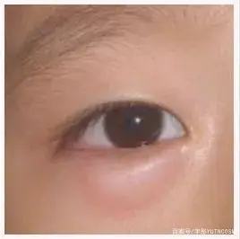 科普|想知道你的眼袋是什么类型的吗?